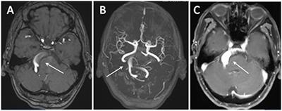 Vertebrobasilar Dolichoectasia and Basilar Artery Dissection Presenting With Trigeminal Neuralgia: A Case Report